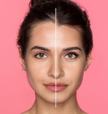 CO2 Laser Skin Resurfacing Before & After Photo - Does It Work?